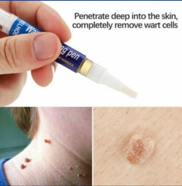 Wart Remover Pen