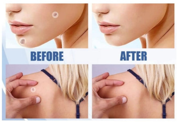 Formu Clear Skin Tag Patches